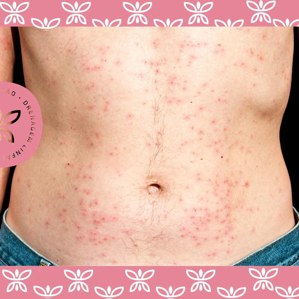 como evitar foliculite após depilação​